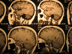 Traumatic Brain Injuries